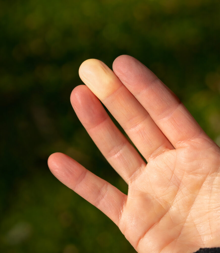 Raynaud's syndrome