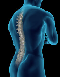 Cauda Equina Syndrome Claims